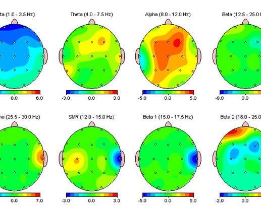 Neurofeedback and qEEG, Explained: What a Brain Map Actually Shows You